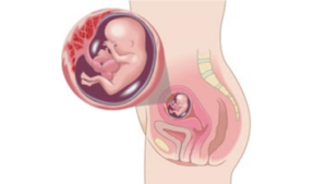 Токсикоз на 12 неделе беременности причины