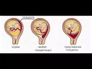 Низкая плацентация при беременности 12 недель что это значит