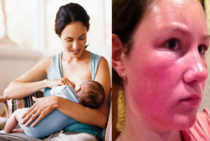 Аллергия у кормящей мамы что делать