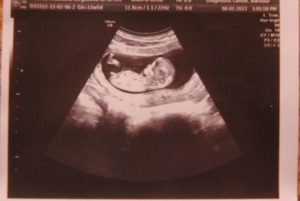 Что показывает первый скрининг в 12 недель беременности