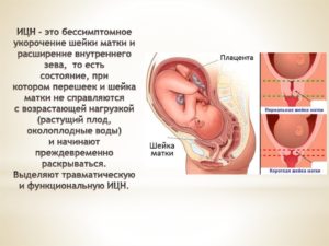 Укороченная шейка матки на 32 неделе беременности thumbnail