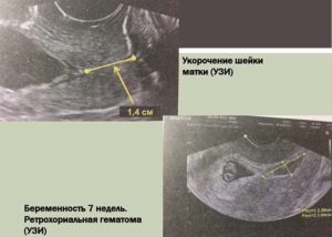 Гематома на 6 неделе беременности