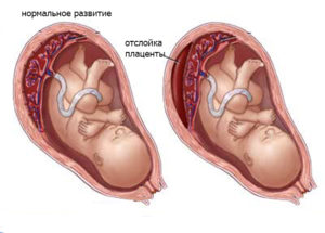 На 18 неделе беременности отслойка плаценты