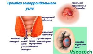 На 35 неделе беременности геморрой