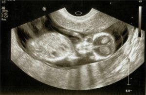 Тонус матки на 13 неделе беременности