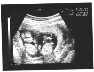 10 неделя беременности двойней