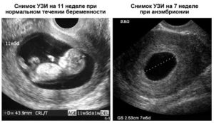 Замершая беременность ошибка узи 12 недель