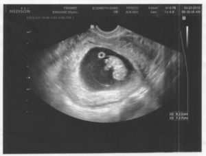 9 недель беременности и 2 дня