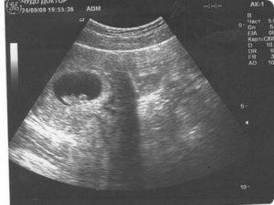 Снимок узи на 3 неделе беременности