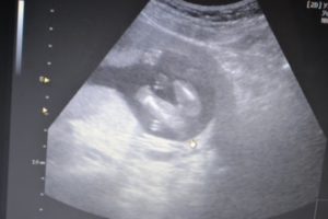 Пол ребенка на 17 неделе беременности
