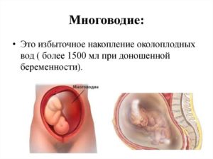 Многоводие при беременности 33 недели лечение