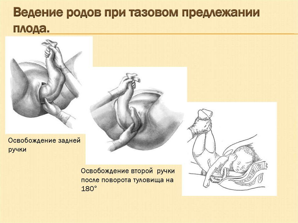 Тазовое предлежание плода на 29 неделе беременности что делать