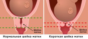 Короткая шейка матки при беременности 35 недель