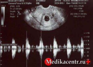 Сердцебиение на 6 неделе беременности узи