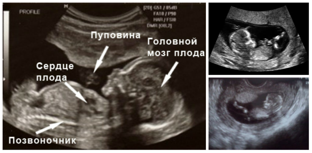 Узи на 13 неделе беременности скрининг