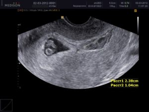 Ретрохориальная гематома при беременности 7 недель