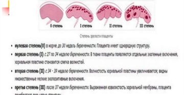 32 недели старение плаценты при беременности