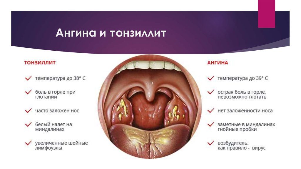 Болит горло на 5 неделе беременности