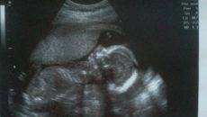 Тонус матки на 16 неделе беременности