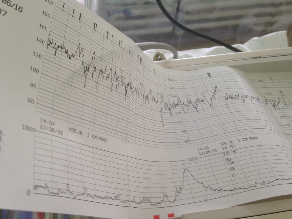Ктг на 40 неделе беременности