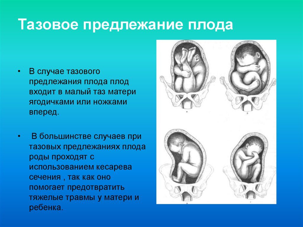 Тазовое предлежание плода на 20 неделе беременности