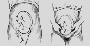 Тазовое предлежание плода на 36 неделе беременности