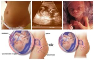 Токсикоз на 17 неделе беременности