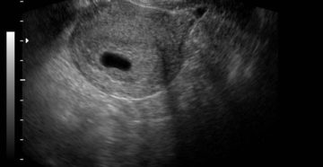 На 5 неделе беременности не видно эмбрион