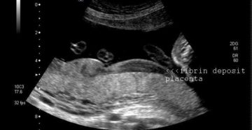 Киста на плаценте при беременности 33 недели