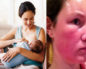 Аллергия у кормящей мамы