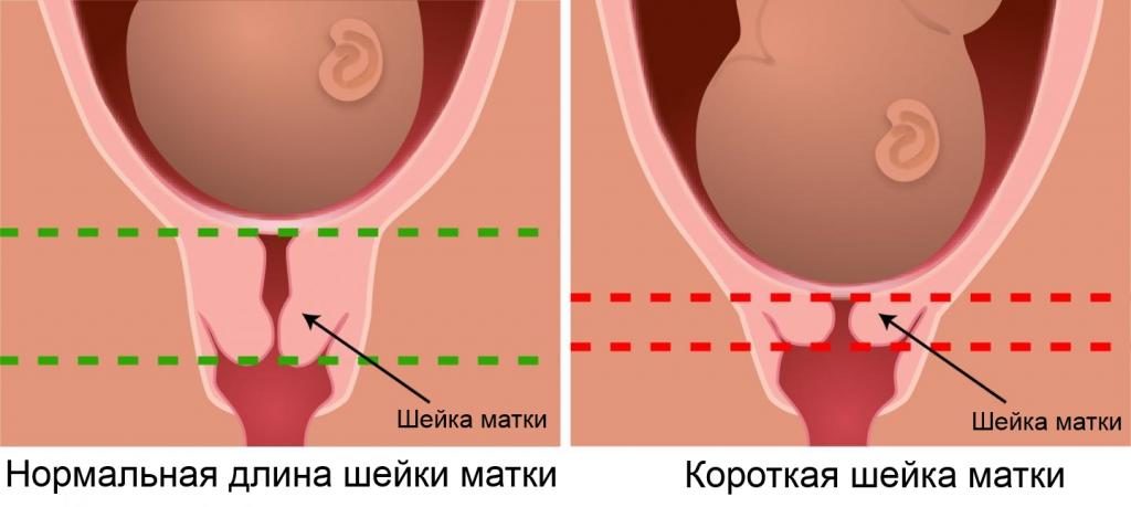 Укороченная шейка матки при беременности 20 недель