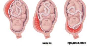32 недели беременности низкая плацентация