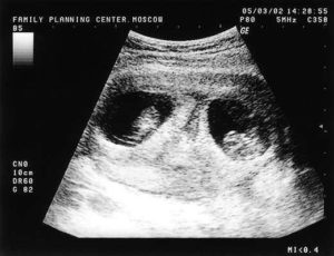 7 недель двойня беременности