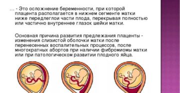 Низкая плацента при беременности 20 недель