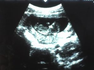 11 недель беременности пол ребенка