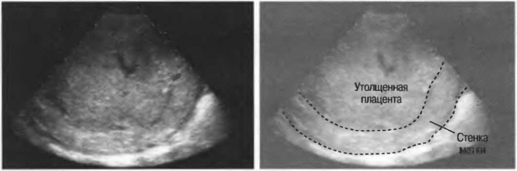 Гиперплазия плаценты при беременности 20 недель