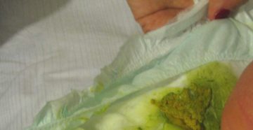 Зеленые какули у новорожденного на искусственном вскармливании