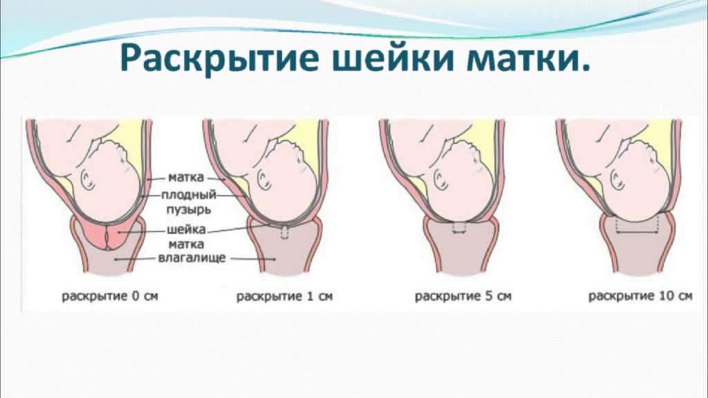 39 неделя беременности как ускорить раскрытие шейки матки