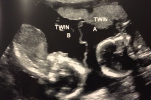 15 неделя беременности двойней