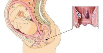 Геморрой на 32 неделе беременности