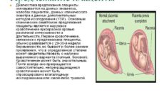 Предлежание плаценты на 32 неделе беременности