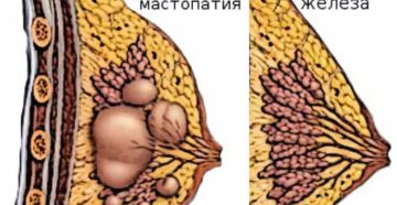 В груди уплотнение у кормящей мамы