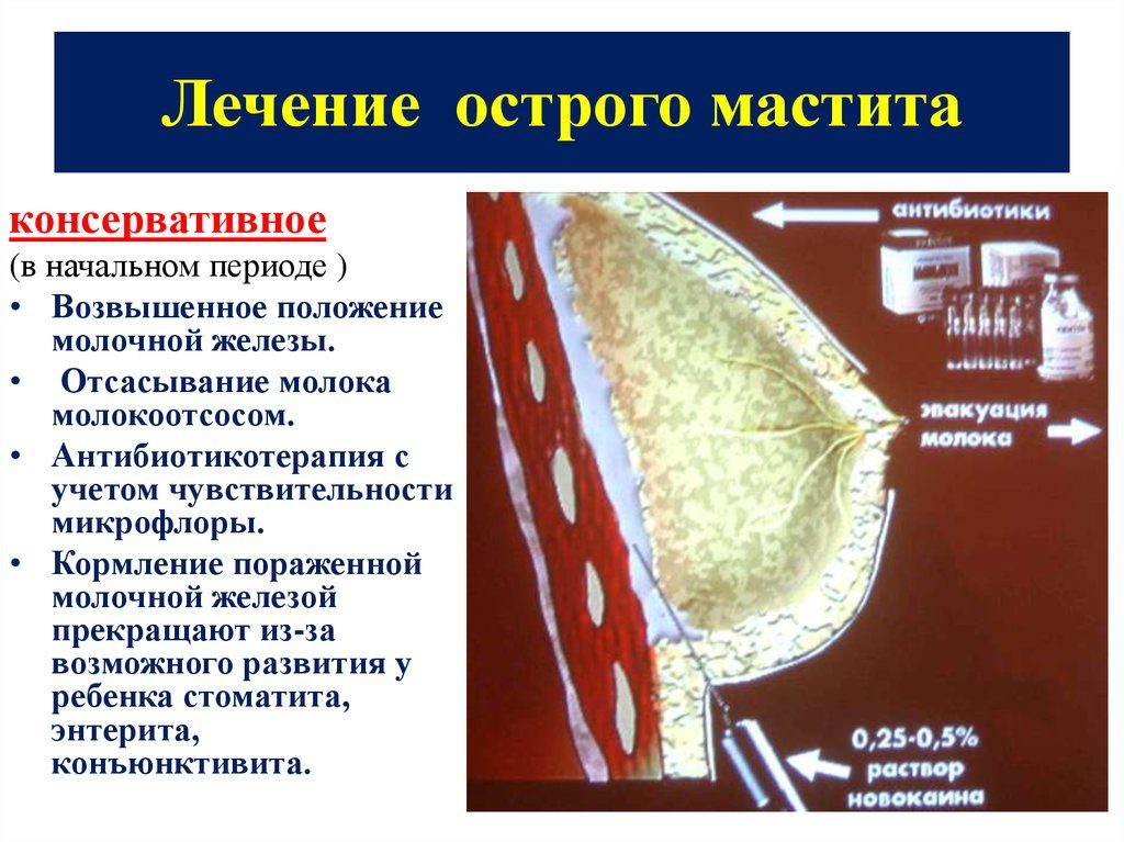 Народные средства от мастита у кормящей мамы