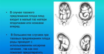 Тазовое предлежание плода на 32 неделе беременности