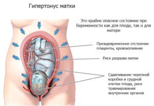 Повышенный тонус матки при беременности в первом триместре