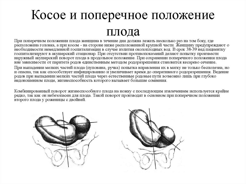 Причины поперечного положения плода после 30 недель беременности