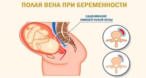 Головокружение на 30 неделе беременности