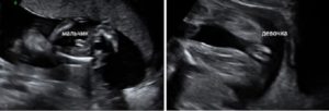 Беременность 17 недель мальчик или девочка