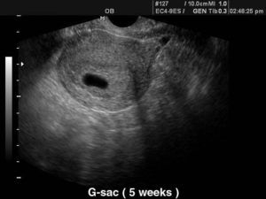 5 недель беременность не видно плодного яйца на узи