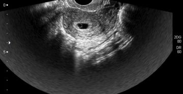 Беременность 4 недели от зачатия размер плодного яйца